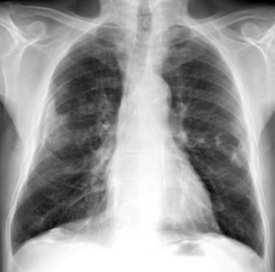 mesothelioma calcified