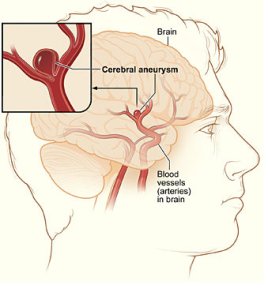 subarachnoid hemorrhage bret michaels