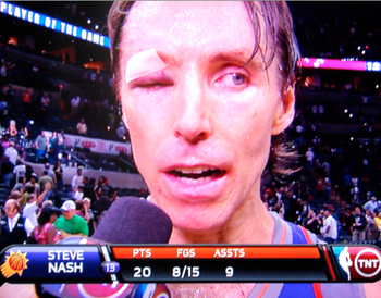 Steve Nash Eye Injury press con | Social Media SEO - 350 x 274 png 173kB