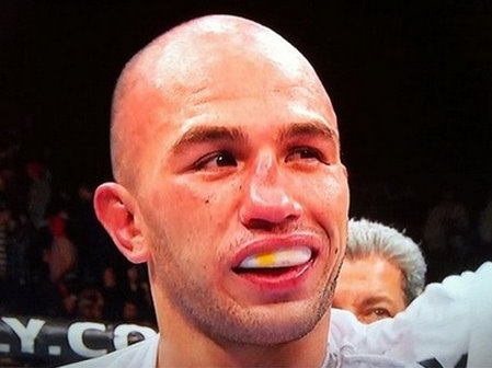 brandon vera broken nose 1